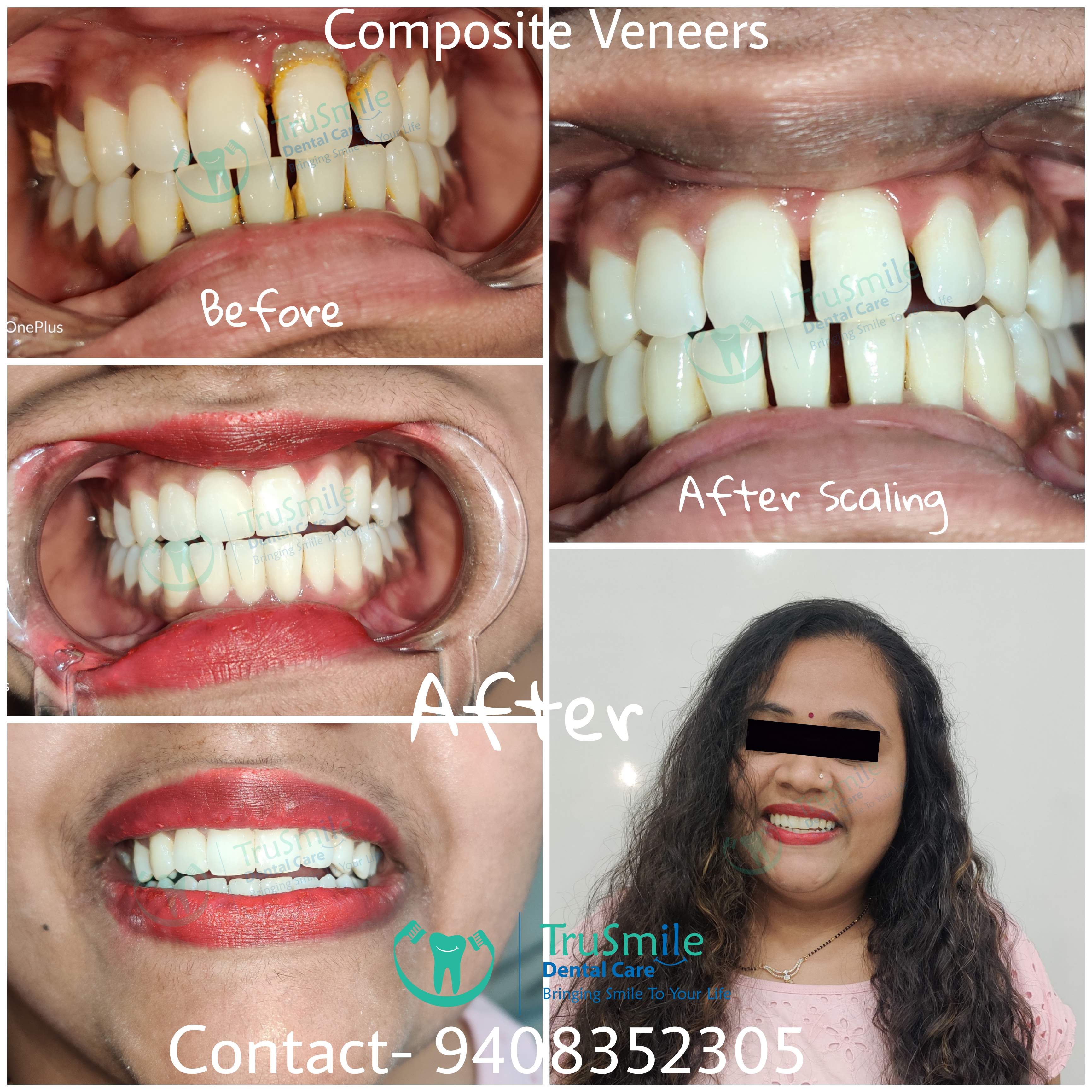 Smile Design 6